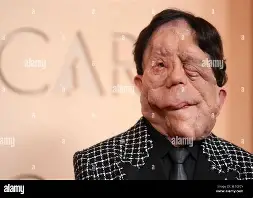 Adam Pearson British actor and disability advocate appearing in the film A Different Man